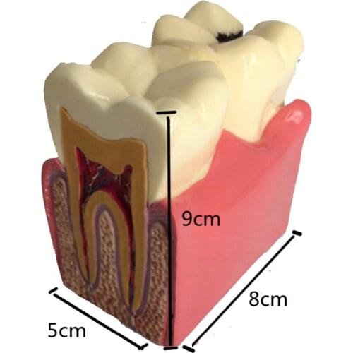 1pc dental teeth model dentist study 6 Times Caries Tooth models Dentist teaching Studying Researching dentistry dental products