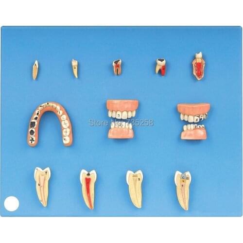 Dental Diseases Model,Dental Pathological Model