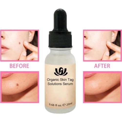 20ml Organic Tags Solutions Serum Rose Cleansing Essential Oil Mole Lotion Skin Tag Liquid Remover Skin Care Product TSLM1