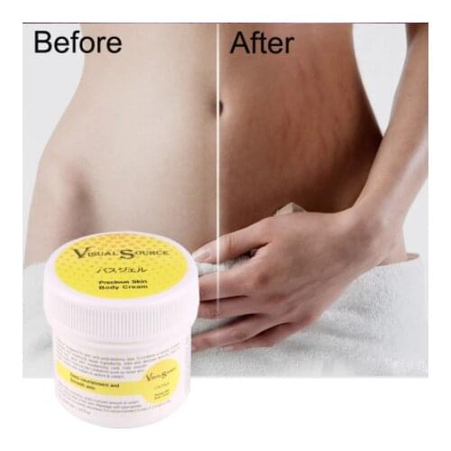 30g Stretch Marks Removal Cream Maternity Scar Skin Gentle Cream Skin Repair Body Cream Products