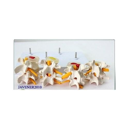 4-Part Human Anatomical Lumbar Vertebra Diseased Contrast Medical Model