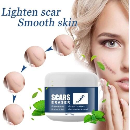 New Scar Acne Cream Pimple Treatment Scar Stretch Marks Removal Cream for New And Old Scar All Skin Types Hot Sell