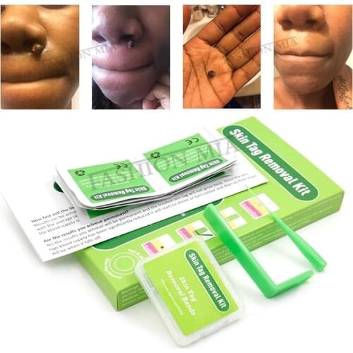 Microband Skin Mole Tag Removal Kit Skin Tag Remover Skin Mole Wart Remover Skin Tag Removal Kit with Cleansing Pads Face Care