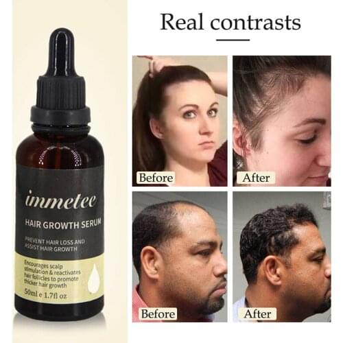 Hair Growth Essence Oil Anti Hair Loss Treatment Hair Thickener Beard Growth for Hair Growth Serum Hair Tonic Hair Care Products