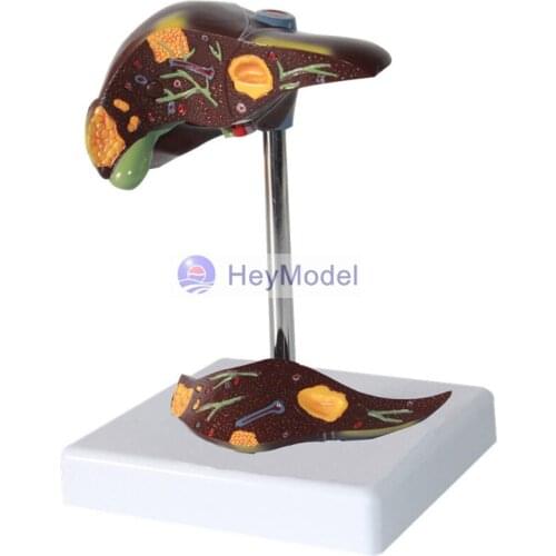HeyModel Liver pathology model liver disease display