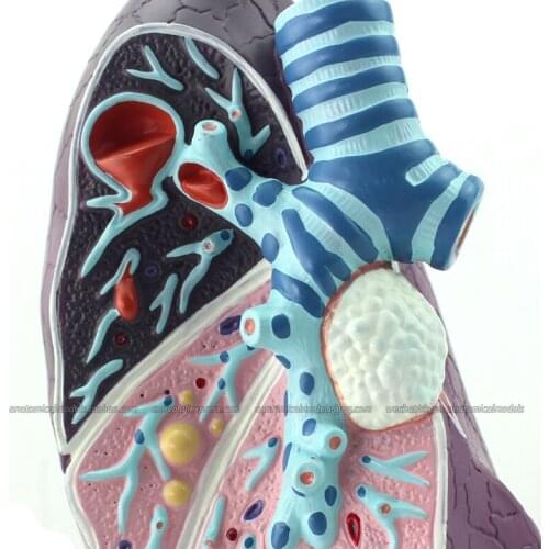 CMAM/12501 Pathological Model of the Lung, 2/3x, Human Respiratory System Medical Teaching Anatomical Model