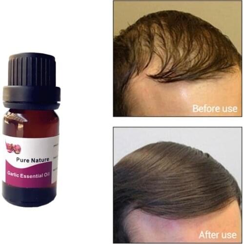 1pcs/10ml Unisex fast hair regrowth treatment nature Garlic essential oil pilatory anti hair loss product thicker hair care oil