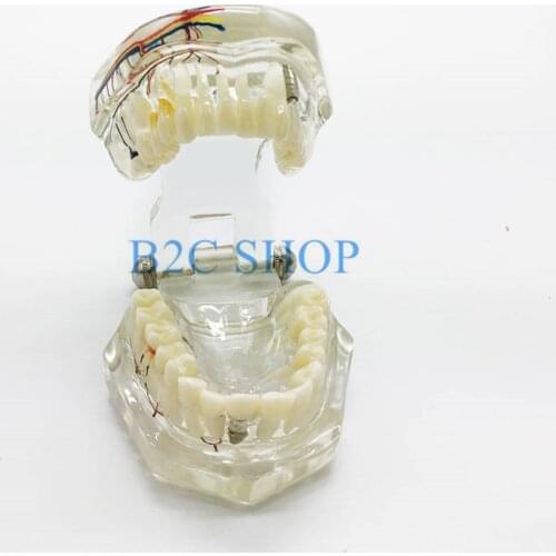 Teeth Model Dental teeth model implant with nerve Transparent pathological Repair model Teaching demonstration model