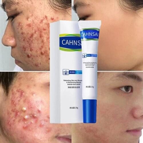 Effective Acne Removal Cream Anti-acne Repair Fade Acne Spots Oil Control Whitening Moisturizing Face Gel Skin Care