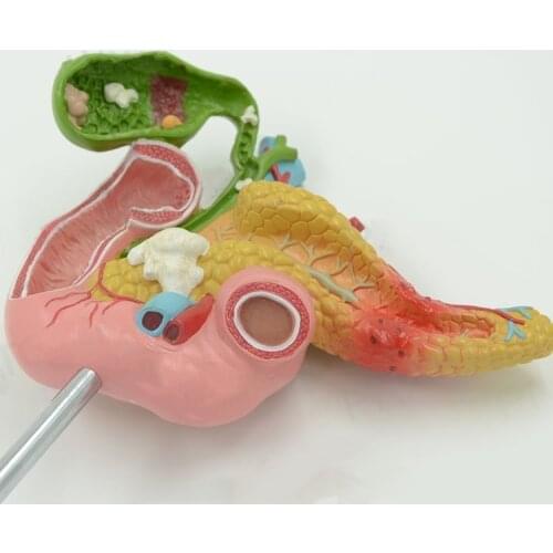 Anatomical model of pathological structure of pancreas, duodenum and gallbladder in medical human body Surgery of internal