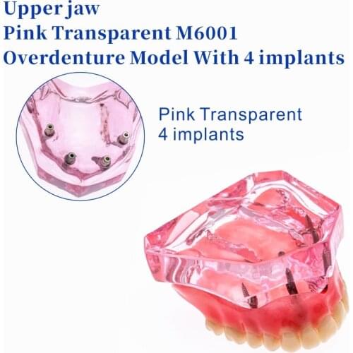 Dental Study Model - Overdenture Superior with 4 Implants Demo Model #6001 01 Teeth Model