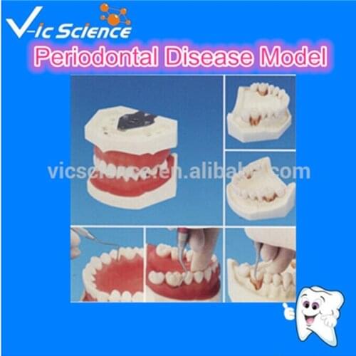 High Quality Periodontal Disease Model