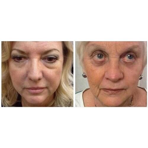 1x 2x 5x 10x 20x Boto x Are ginine Face Lift Skin Care Product Powerful Anti-wrinkle Anti-aging