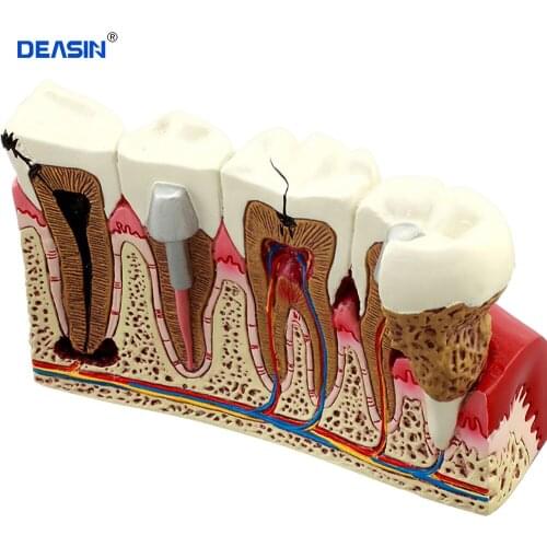 Dental Anatomy of dental caries plastic teeth model demonstration communication