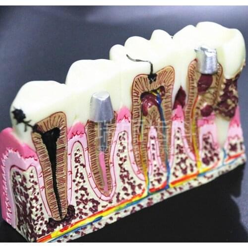 Dentistry Dental caries anatomy model Doctor-patient communication Dental nerve oral model free shipping