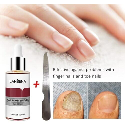 LANBENA Nail Repair Essence Serum Fungal Nail Treatment Remove Onychomycosis Toe Nourishing Brighten Hand Foot Skin Care 12ml