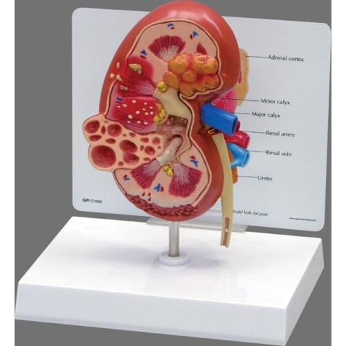 Pathological Model Of Kidney Disease Models, Models Of Kidney Stones, Double-Sided, Normal & Pathological Anatomy Display