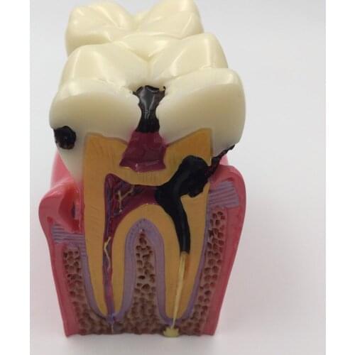 High quality NEW Denture Teeth model 6X, caries comparison model, tooth decay model,Dentist for Medical Science Teaching