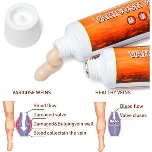 20g Varicosity Angiitis Remedy Ointment Relief Veins Pain Varicose Veins Treatment Cream Phlebitis Legs Varicose Veins Cream