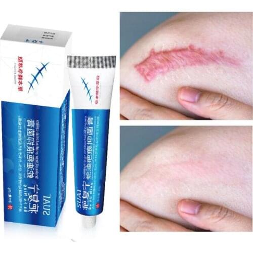 15g Scar Removal Cream Acne Scars Gel Stretch Marks Surgical Scar Burn For Body Pigmentation Corrector Acne Spots Repair Care