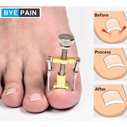 1Pcs BYEPAIN Ingrown Toenails Fixer Orthotics Toe Nail Recover Correction Tool Nail Care Device Manicure Pedicure Set