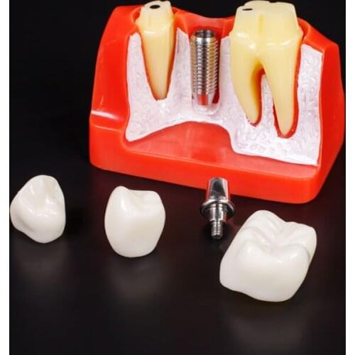 4 Times Teeth Model Dental Implant Analysis Crown Bridge Demonstration Dental Teeth Model Dentist Tools Study Model