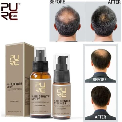 20ML/30ML Hair Growth Spray Ginger Extract Ingredients Prevent Hair Loss Growth OilTreatment Hair Care Products
