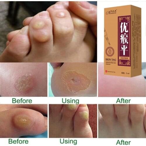 5ML Skin Tag Remover Anti Foot Corn Removal Warts Papillomas Rapidly Removes Moles Against Mole & Genital Wart Skin Care Tools