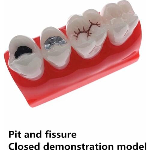 Dental Study teeth Model Dental pit and fissure closed model Treatment Teeth Model