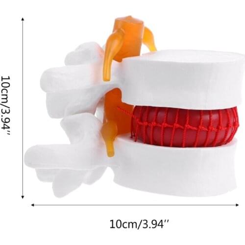 Human Anatomical Lumbar Disc Herniation Model Medical Learn Aid Anatomy Instrume 19QA