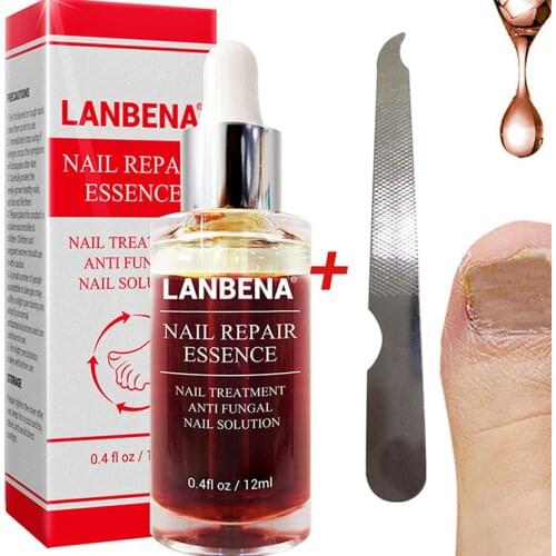 Schimmel Nagel Reparatie Essentie Serum foot hand Care Behandeling Voet Nagel Schimmel Verwijdering Anti Infectie Paronychia