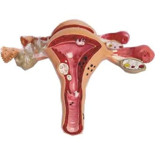 Pathological model of M27 uterus