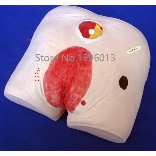 Decubitus Ulcer Care Model, Pressure Sore Simulator