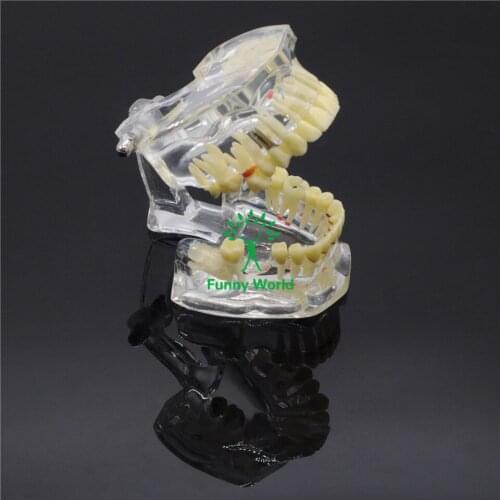 1 X Dental Implant Disease Tooth Pathological Extrusion Missing Teeth Model New