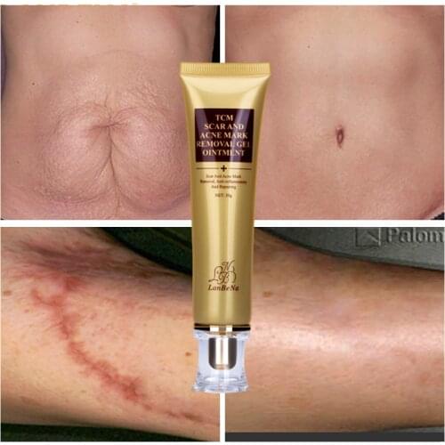 Acne Scar Removal gel Skin Stretch Marks Repair Anti Spots Acne Treatment Blackhead Whitening cream Shrink Pores Skin Care 30g