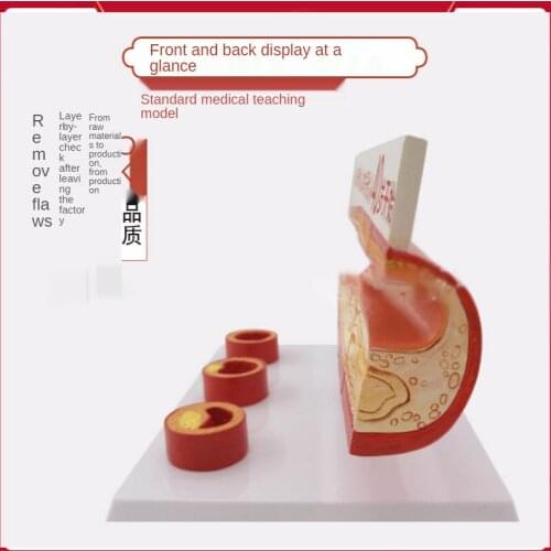 Thrombosis model Display model of age vessels at different stages of cardiovascular arteriosclerosis of human atherosclerosis