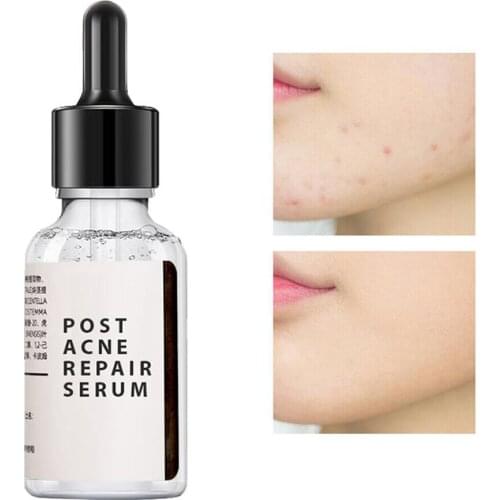 30ml Salicylic Acid 2% Solution Removes Acne Face Serum Shrinks Pore Moisturizing Essence Fade Spot Brighten Face Skin Care