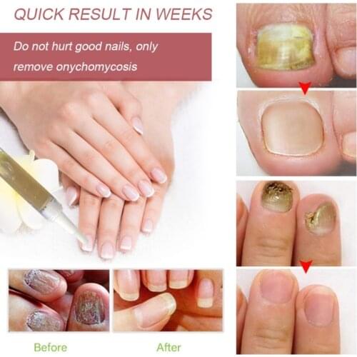 Y1UF Anti-fungal Home Treatment Set Anti Fungal Fungus Care Repair Serum Kit Toe Nail Treatment Pen Onychomycosis Paronychia
