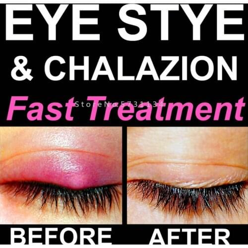 Before and After Eye Stye and Chalazion Removal Remover Relief Eyelid Bump