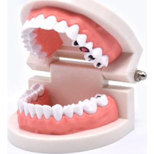 Decayed tooth model，Oral model，Dental model，Teaching model of cavities in children