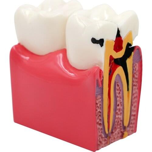 1pc Dental Materials Lab Teeth Model 6 Times Caries Comparation Study Models For Dentist Stomatology Education Researching Tool