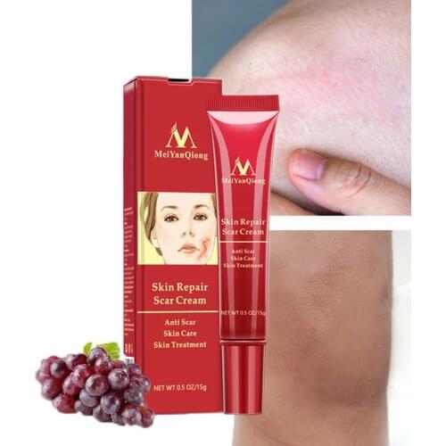Acne Scar Removal Face Cream Acne Spots Acne Pigmentation Corrector Whitening Cream Anti Scar Stretch Marks Repair Skin Care
