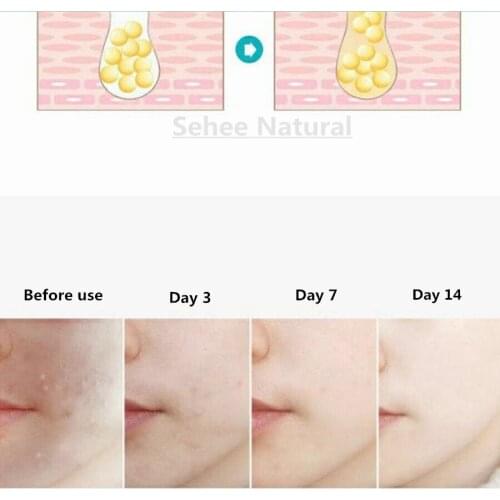 Salicylic Acid Essence Black Head Closed Acne Oil Control Pore Shrinkage Desalination Fine Lines Firming Serum