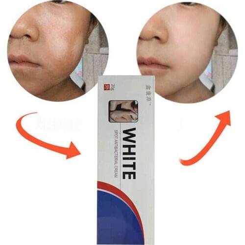 Chinese Medical White Spot Disease Cream Pigment Melanin Promoting Liniment Skin Care Vitiligo Leukoplakia Disease Treatment 20g