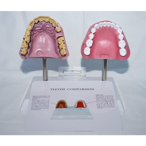 Smoking oral teeth and normal oral teeth comparison model