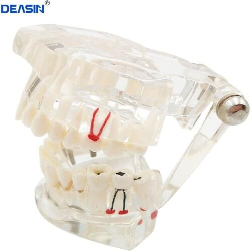 Dental Implant Disease Teeth Model With Restoration Bridge Tooth Dentist For Medical Science Dental Disease Teaching Study