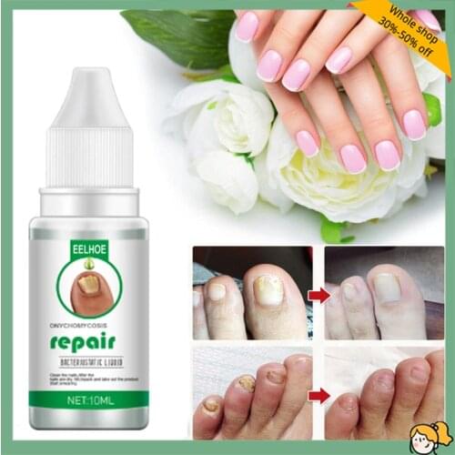 10/20/30ML Nail repair liquid Fungus Treatments Feet Care Essences Fungal Nail Foot Toe Repair Removal Gel