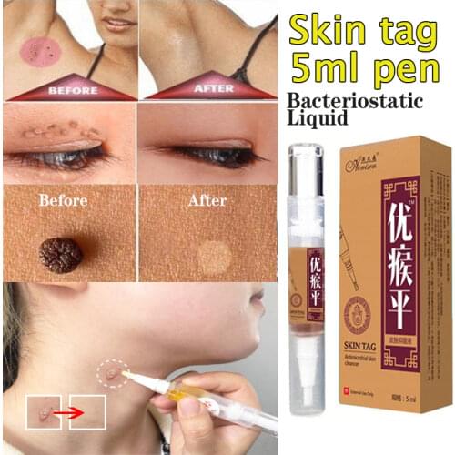 Effective Skin Tag Remover 12h Medical Fast Removal Mole&Genital Anti Wart Bacteriostatic Wart Foot Corn Treatment Kit Skin Care