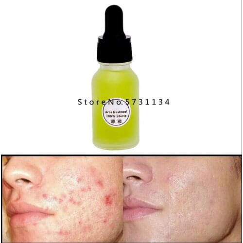 Strong Acne Spots Removal Acne Treatment Face Cream Blackhead Repair Gel Serum Shrink Pores Scar Whitening Moisturizer Skin Care