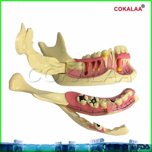 Good quality Mandibular tissue decomposition model dental teeth model dentures teeth model for dentists learning